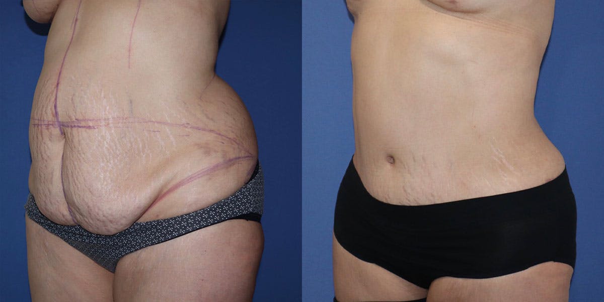 Tummy Tuck Before & After Gallery - Patient 63244657 - Image 2