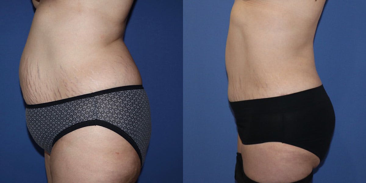 Tummy Tuck Before & After Gallery - Patient 63244657 - Image 3