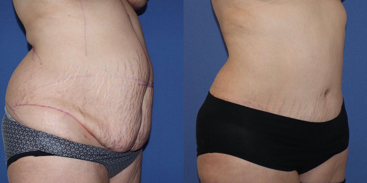 Tummy Tuck Before & After Gallery - Patient 63244657 - Image 4