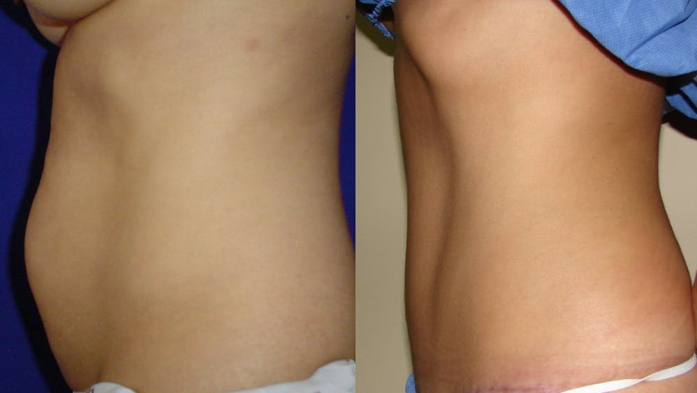 Tummy Tuck Before & After Gallery - Patient 63244658 - Image 2