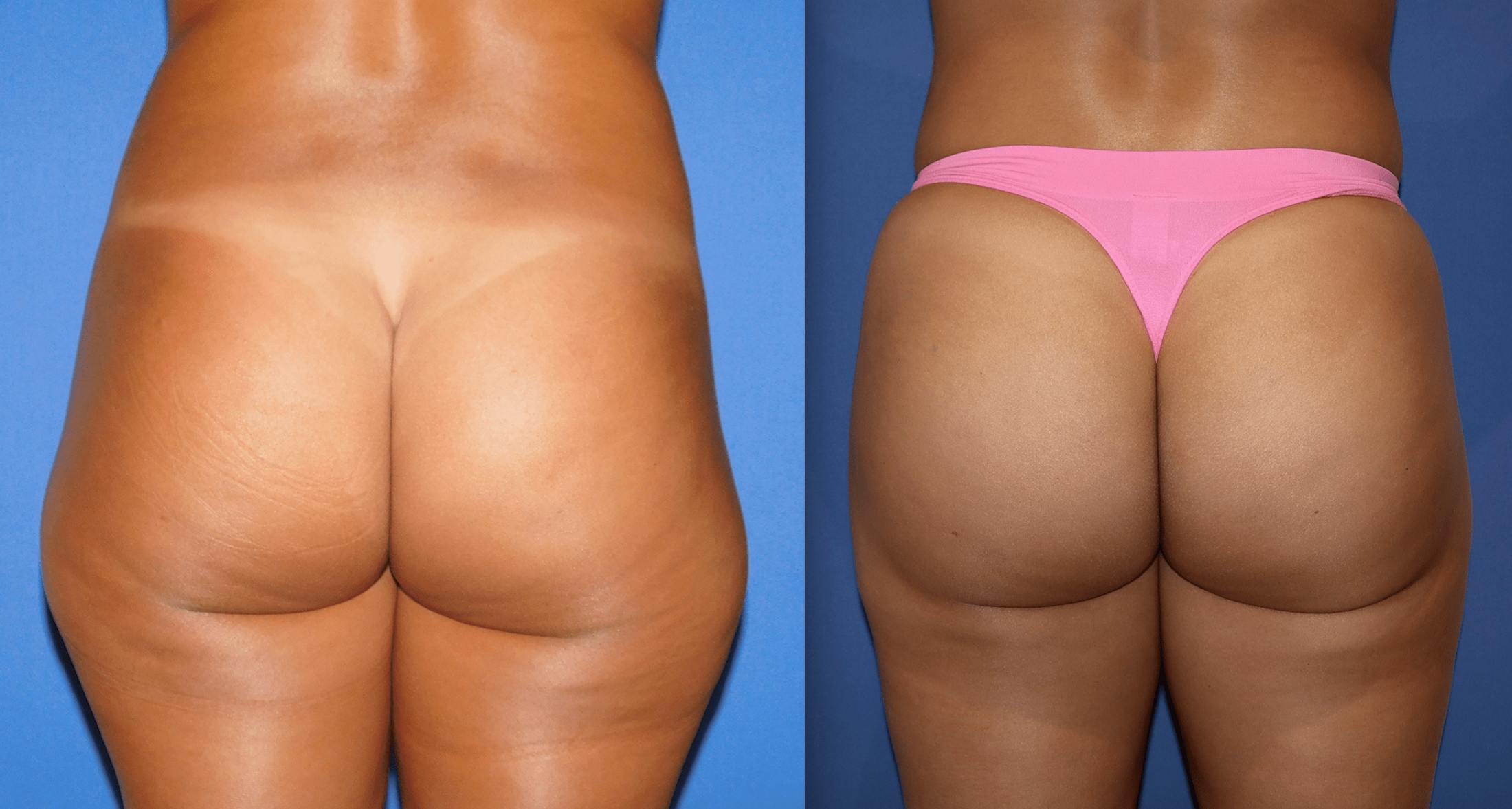 Brazilian Butt Lift Before & After Gallery - Patient 63244687 - Image 1