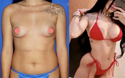 Breast Augmentation Before & After Gallery - Patient 63244696 - Image 1