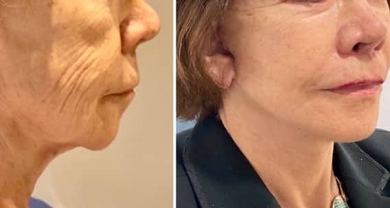 Neck Lift Before & After Gallery - Patient 63244773 - Image 1