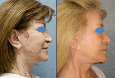 Facelift Before & After Gallery - Patient 63244743 - Image 1