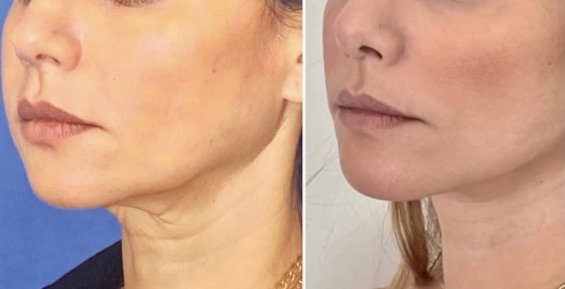 Neck Lift Before & After Gallery - Patient 63244779 - Image 1