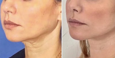 Neck Lift Before & After Gallery - Patient 63244779 - Image 1