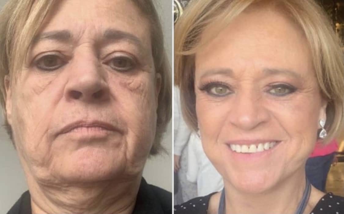 Facelift Before & After Gallery - Patient 63244748 - Image 1