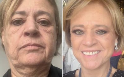 Neck Lift Before & After Gallery - Patient 63244780 - Image 1