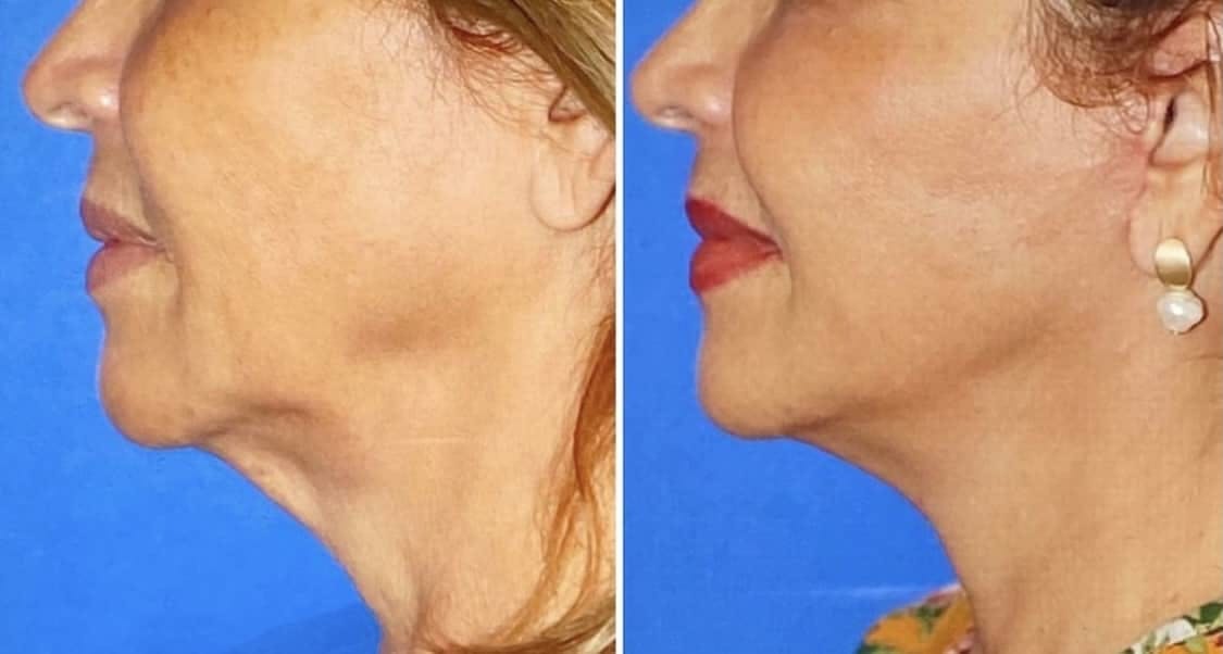 Facelift Before & After Gallery - Patient 63244749 - Image 1