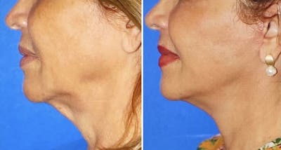 Neck Lift Before & After Gallery - Patient 63244781 - Image 1