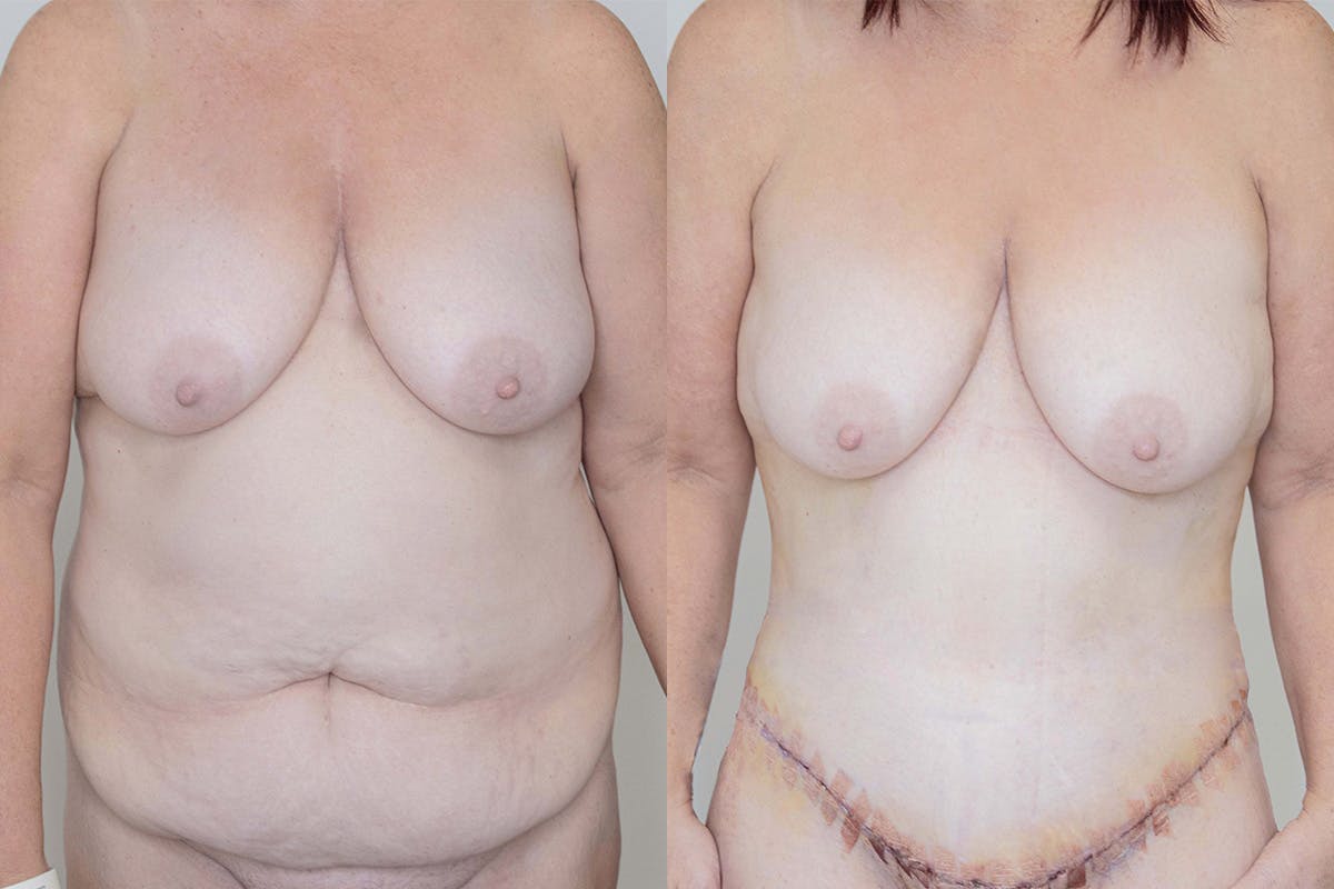 Tummy Tuck Before & After Gallery - Patient 64084025 - Image 1