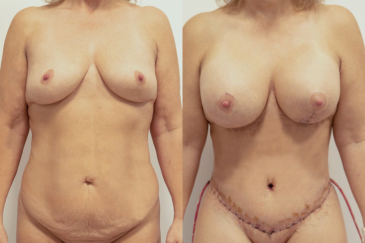 Tummy Tuck Before & After Gallery - Patient 64084044 - Image 1