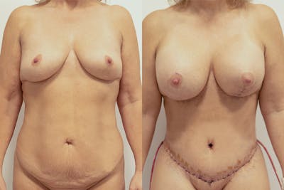 Lipotransfer Before & After Gallery - Patient 64084045 - Image 1