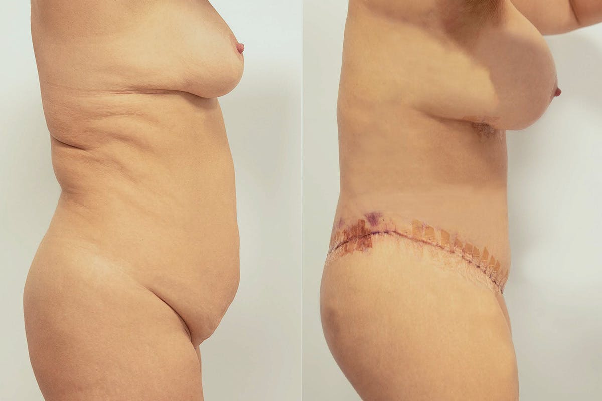 Lipotransfer Before & After Gallery - Patient 64084045 - Image 3