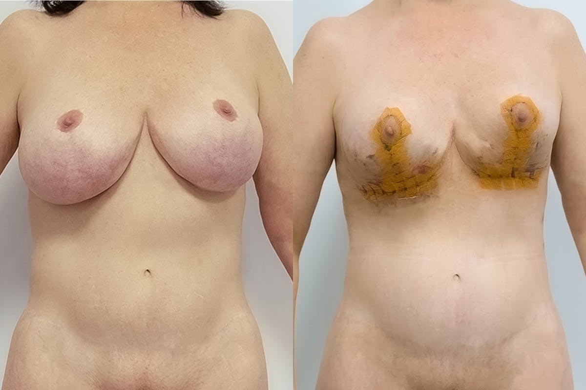 Breast Revision Before & After Gallery - Patient 64084066 - Image 1