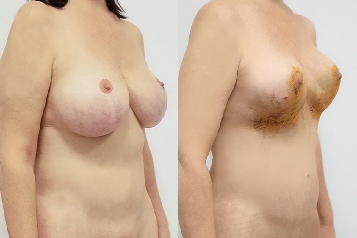 Breast Revision Before & After Gallery - Patient 64084066 - Image 2
