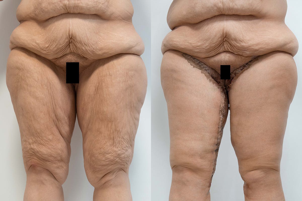 Body Lift Before & After Gallery - Patient 64084210 - Image 1