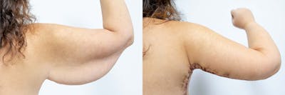 Arm Lift Before & After Gallery - Patient 64084214 - Image 1