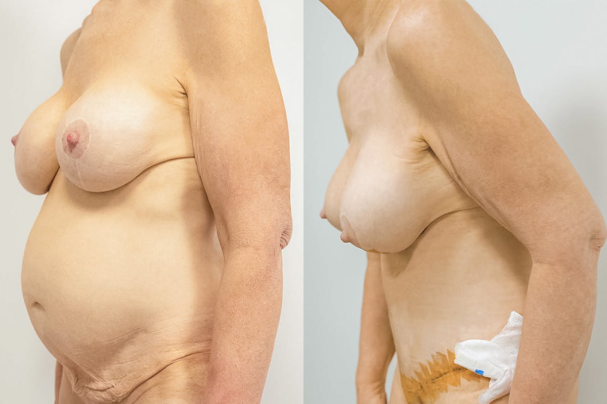 Liposuction Before & After Gallery - Patient 64084225 - Image 2