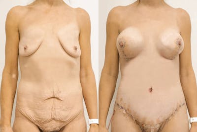 Breast Lift with Implants Before & After Gallery - Patient 64084230 - Image 1