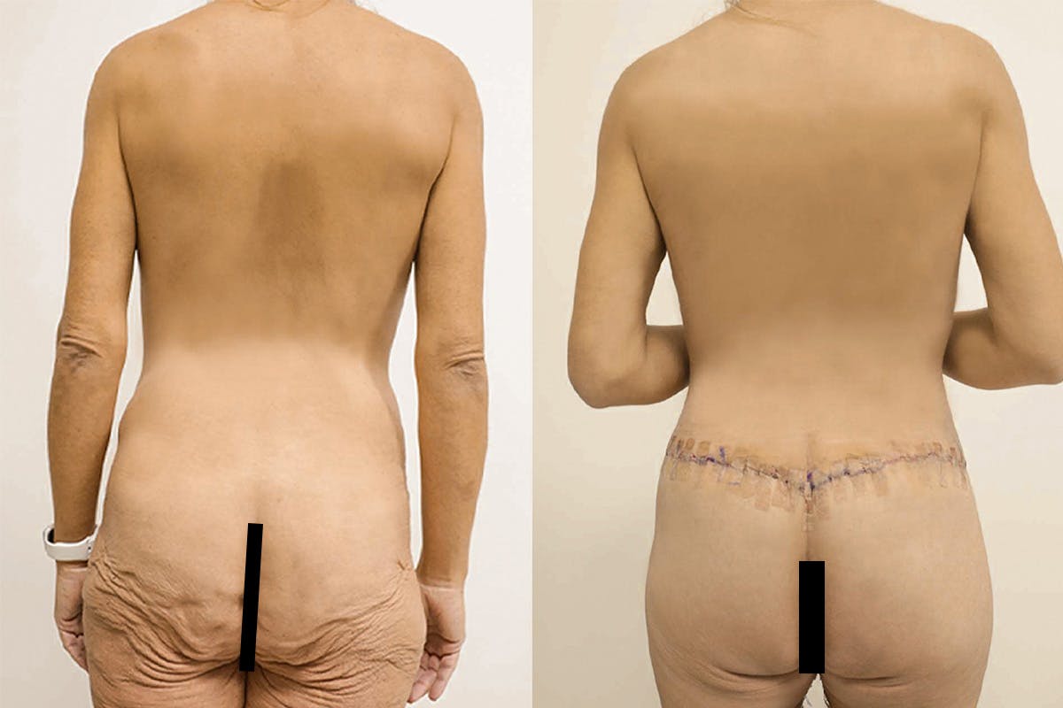 Breast Lift with Implants Before & After Gallery - Patient 64084230 - Image 3