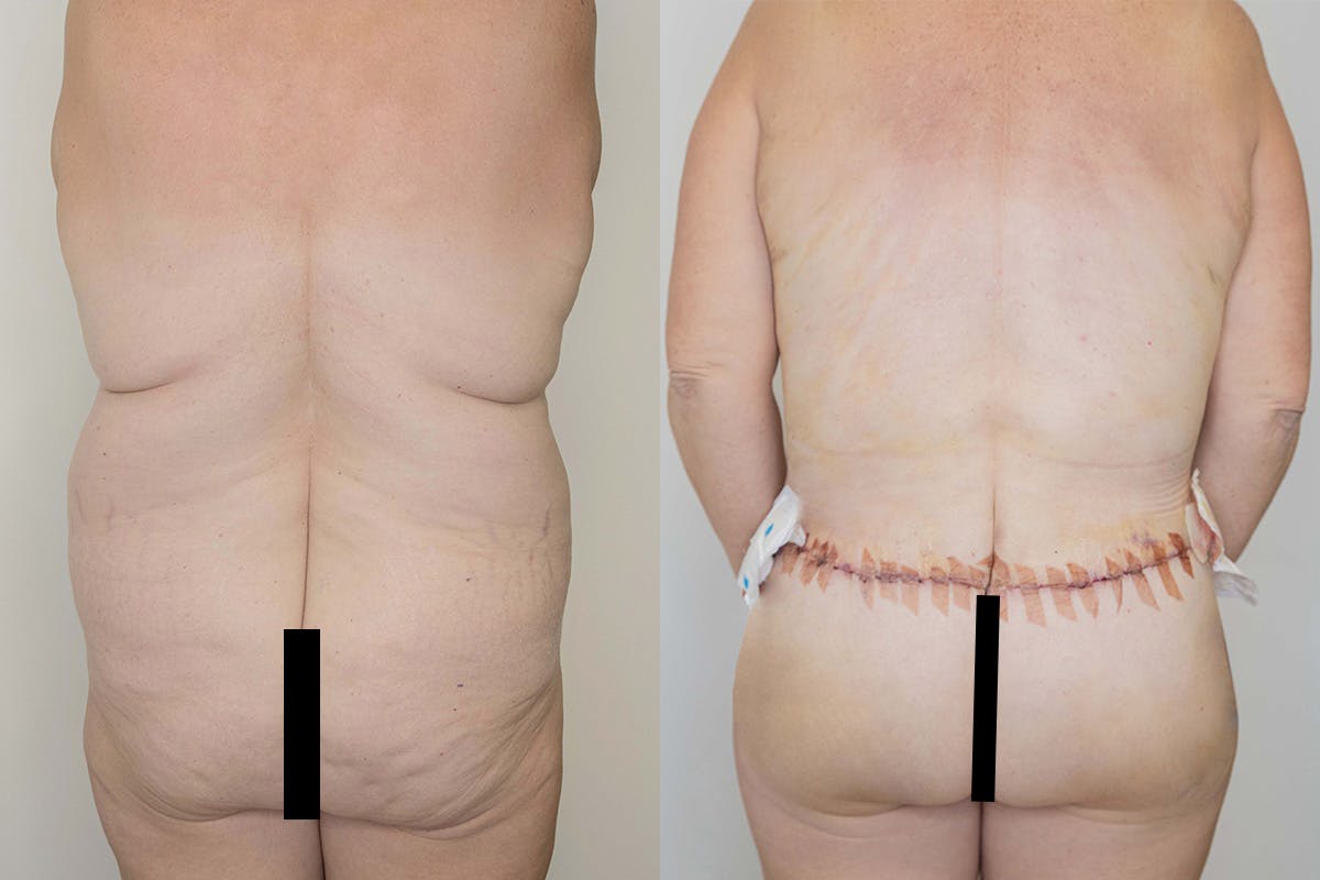 Liposuction Before & After Gallery - Patient 64084026 - Image 5