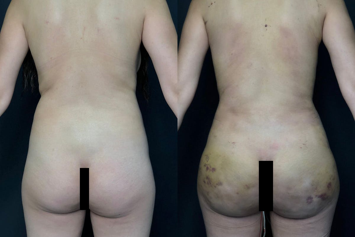 Liposuction Before & After Gallery - Patient 56112279 - Image 1