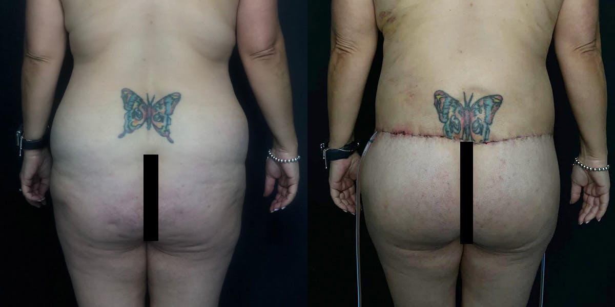 Liposuction Before & After Gallery - Patient 56112253 - Image 1