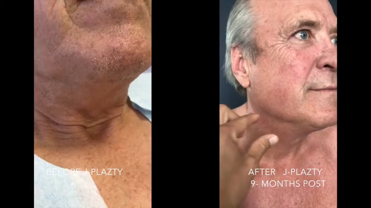 Before and after a J Plasma Neck Lift in Richmond, Virginia with the Virginia Institute of Plastic Surgery