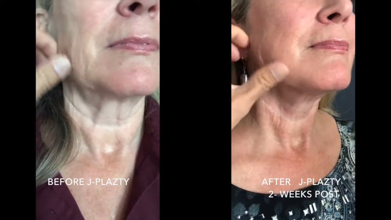 Before and after a J Plasma Neck Lift