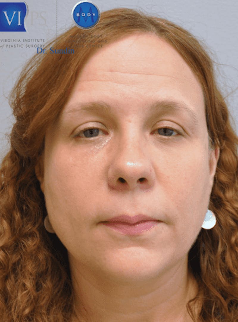 Belotero Before & After Gallery - Patient 55343123 - Image 1