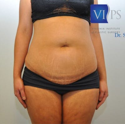 BodyTite Before & After Gallery - Patient 55343128 - Image 1