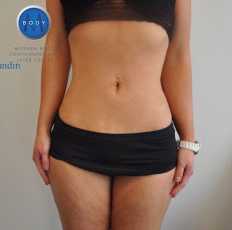 BodyTite Before & After Gallery - Patient 55343128 - Image 2