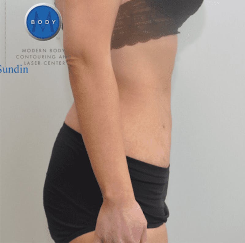 BodyTite Before & After Gallery - Patient 55343128 - Image 6