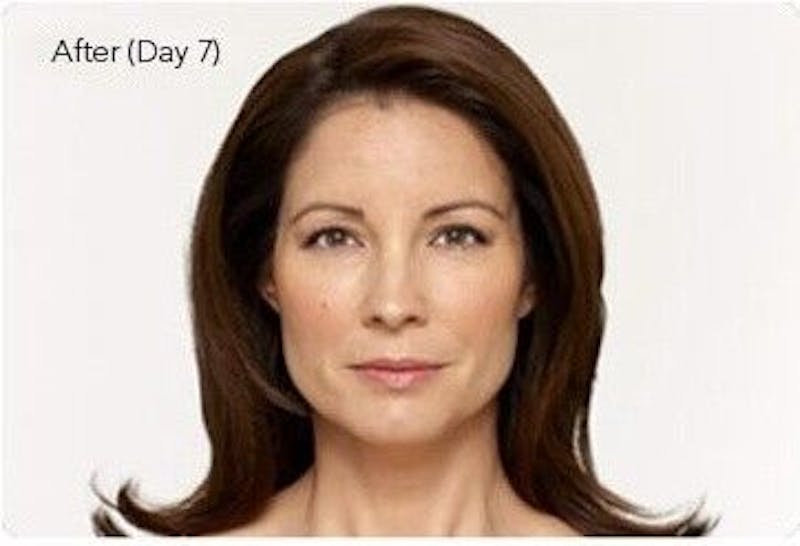 BOTOX Before & After Gallery - Patient 55343132 - Image 1