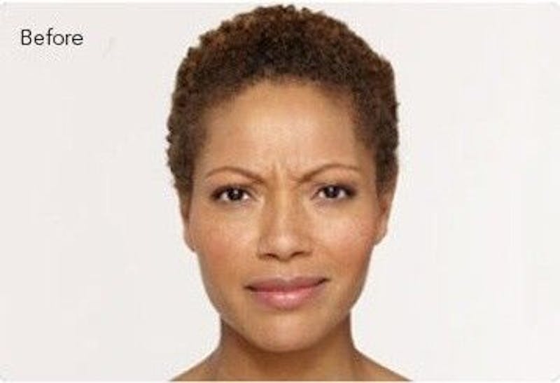 BOTOX Before & After Gallery - Patient 55343133 - Image 1