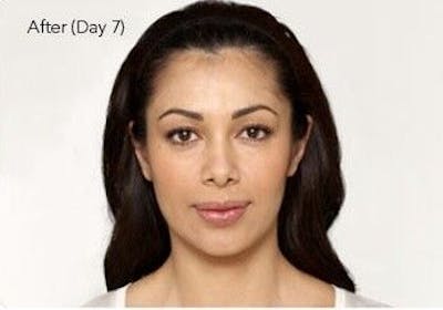 BOTOX Before & After Gallery - Patient 55343134 - Image 2