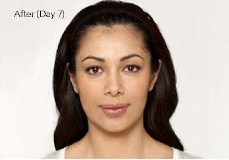 BOTOX Before & After Gallery - Patient 55343134 - Image 2