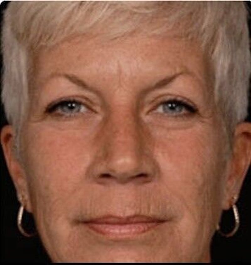 CO2 Laser Before & After Gallery - Patient 55343136 - Image 1