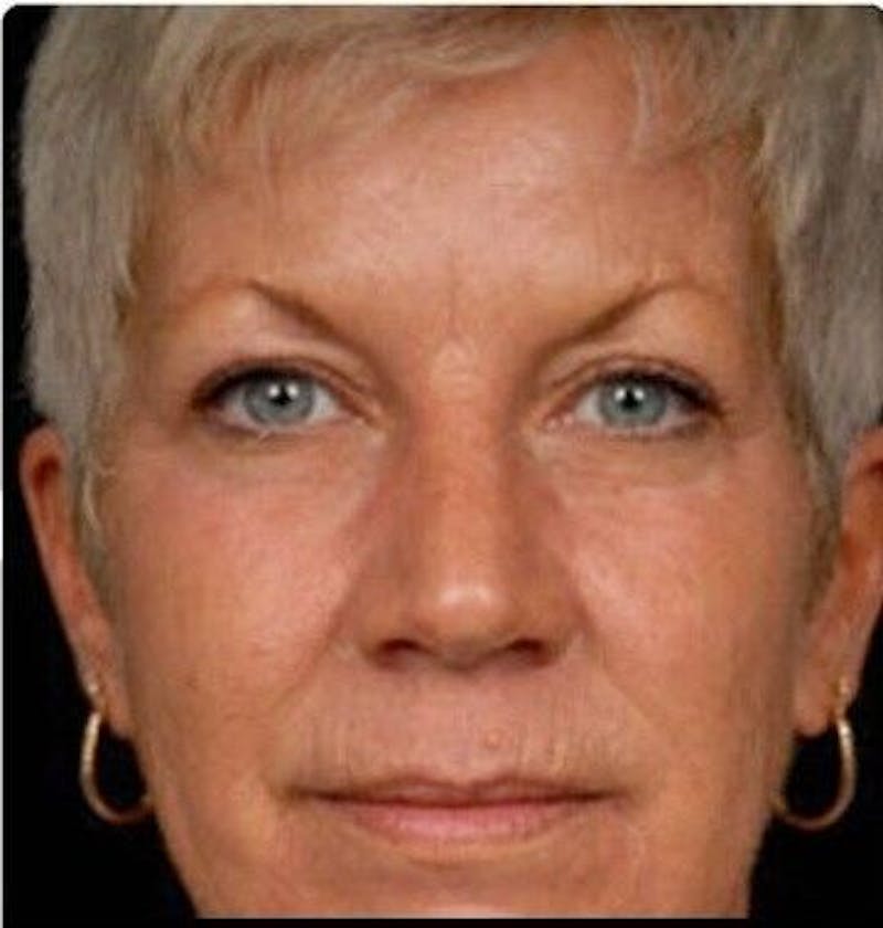 CO2 Laser Before & After Gallery - Patient 55343136 - Image 2