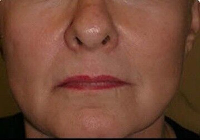 CO2 Laser Before & After Gallery - Patient 55343137 - Image 1