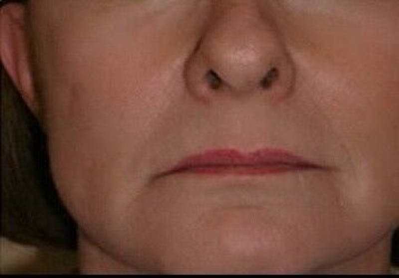 CO2 Laser Before & After Gallery - Patient 55343137 - Image 2
