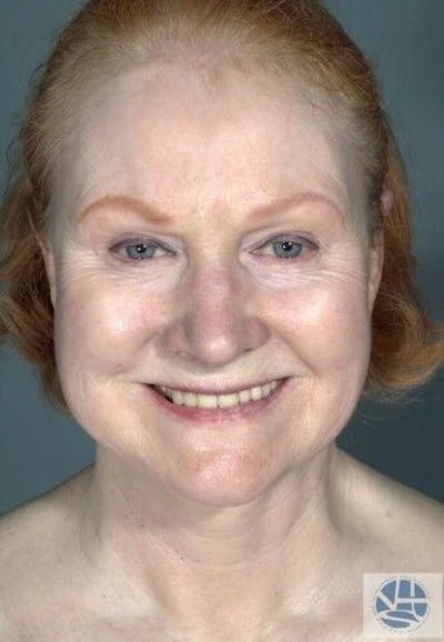 CO2 Laser Before & After Gallery - Patient 55343146 - Image 1