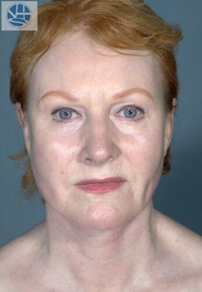 CO2 Laser Before & After Gallery - Patient 55343146 - Image 2