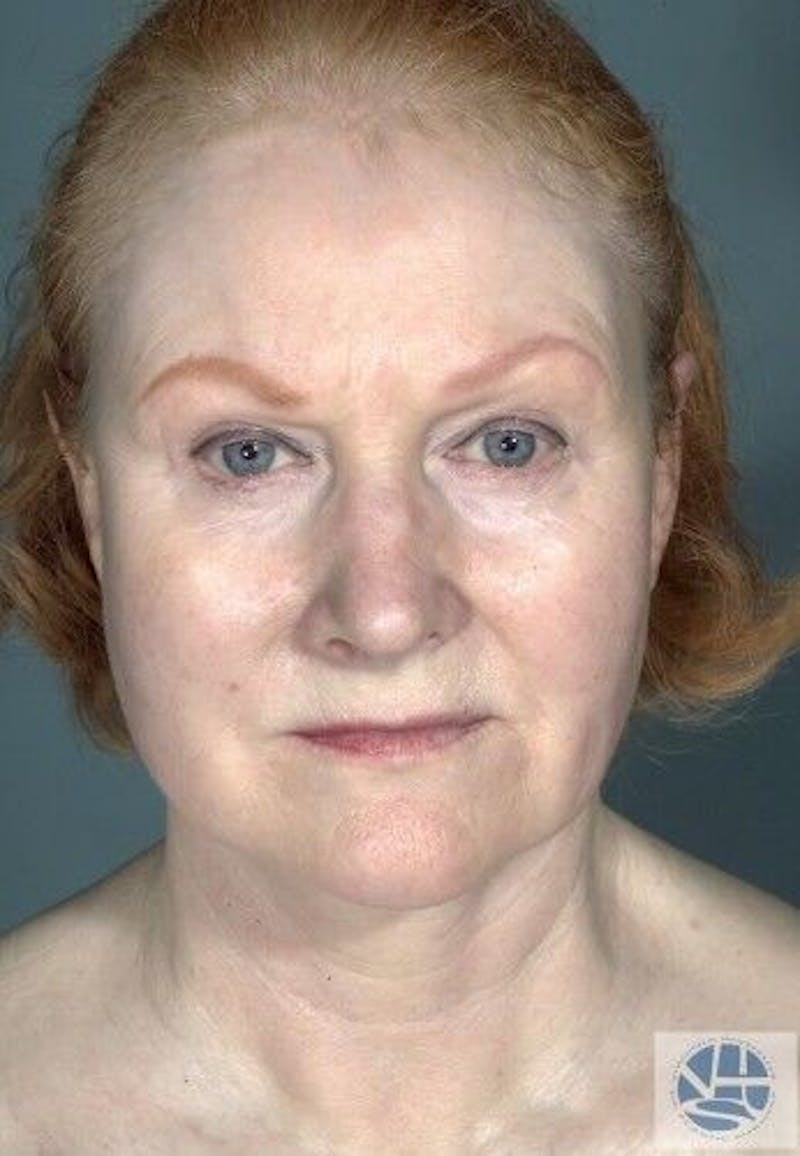 CO2 Laser Before & After Gallery - Patient 55343146 - Image 3
