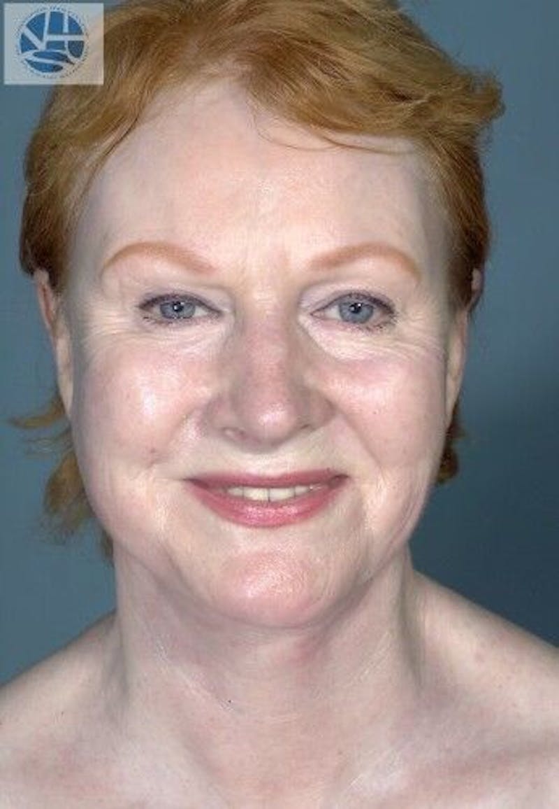 CO2 Laser Before & After Gallery - Patient 55343146 - Image 4