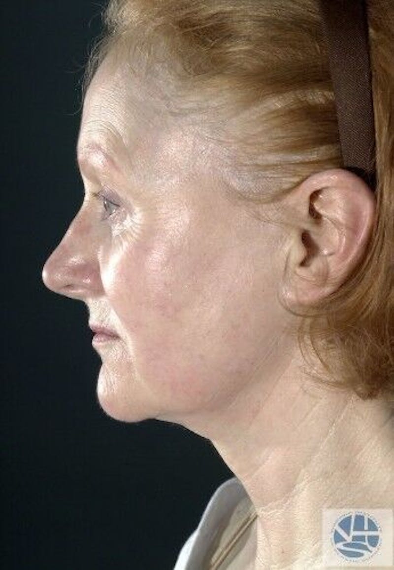 CO2 Laser Before & After Gallery - Patient 55343146 - Image 5