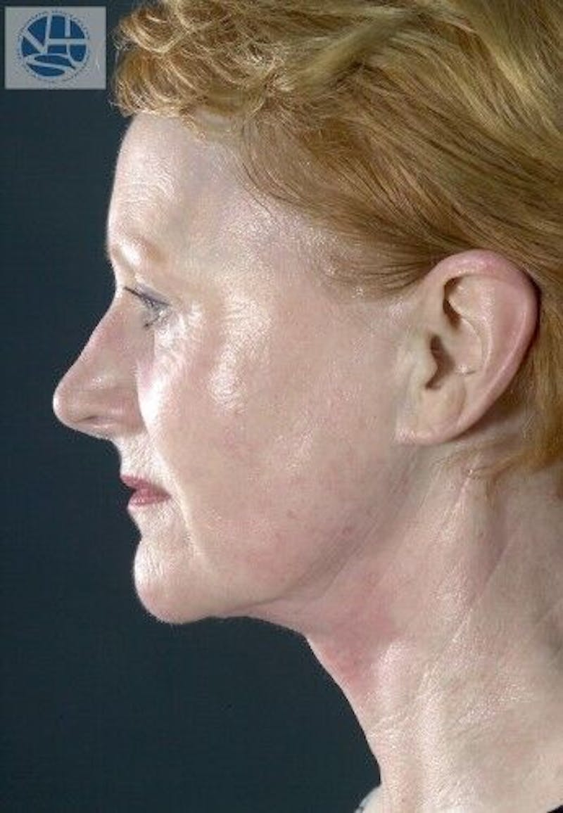 CO2 Laser Before & After Gallery - Patient 55343146 - Image 6