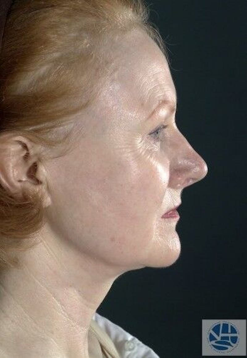 CO2 Laser Before & After Gallery - Patient 55343146 - Image 7