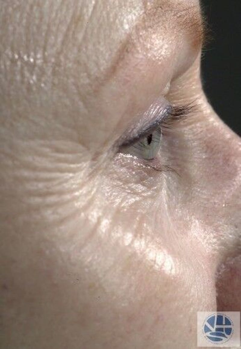 CO2 Laser Before & After Gallery - Patient 55343146 - Image 9